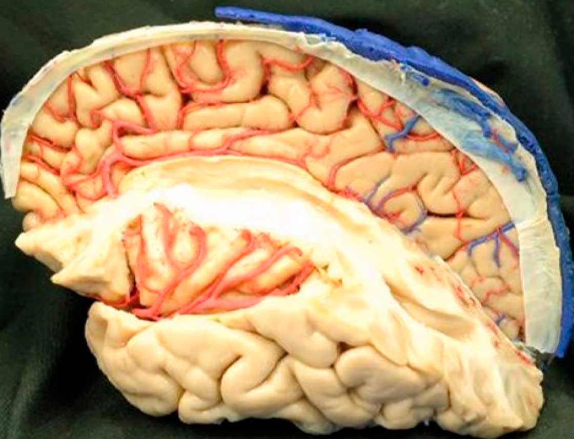 Anatomia Microcirúrgica Tridimensional Da Ínsula