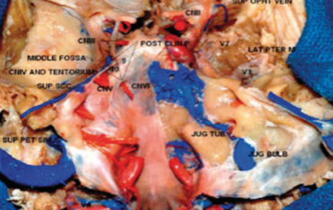 Anatomia microcirúrgica do seio cavernoso: Medidas dos triângulos dentro e por volta dele