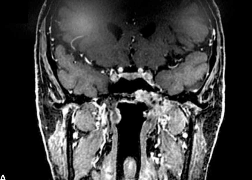 Fossa Pterigopalatina: Anatomia Microcirúrgica E Sua Relevância Para A Cirurgia Da Base Do Crânio