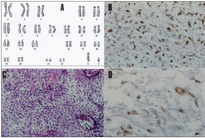 Condrosarcoma de Base de Crânio e Síndrome de Maffucci