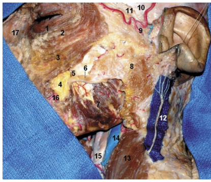 Fossa Infratemporal: Microanatomia E Abordagens Cirúrgicas