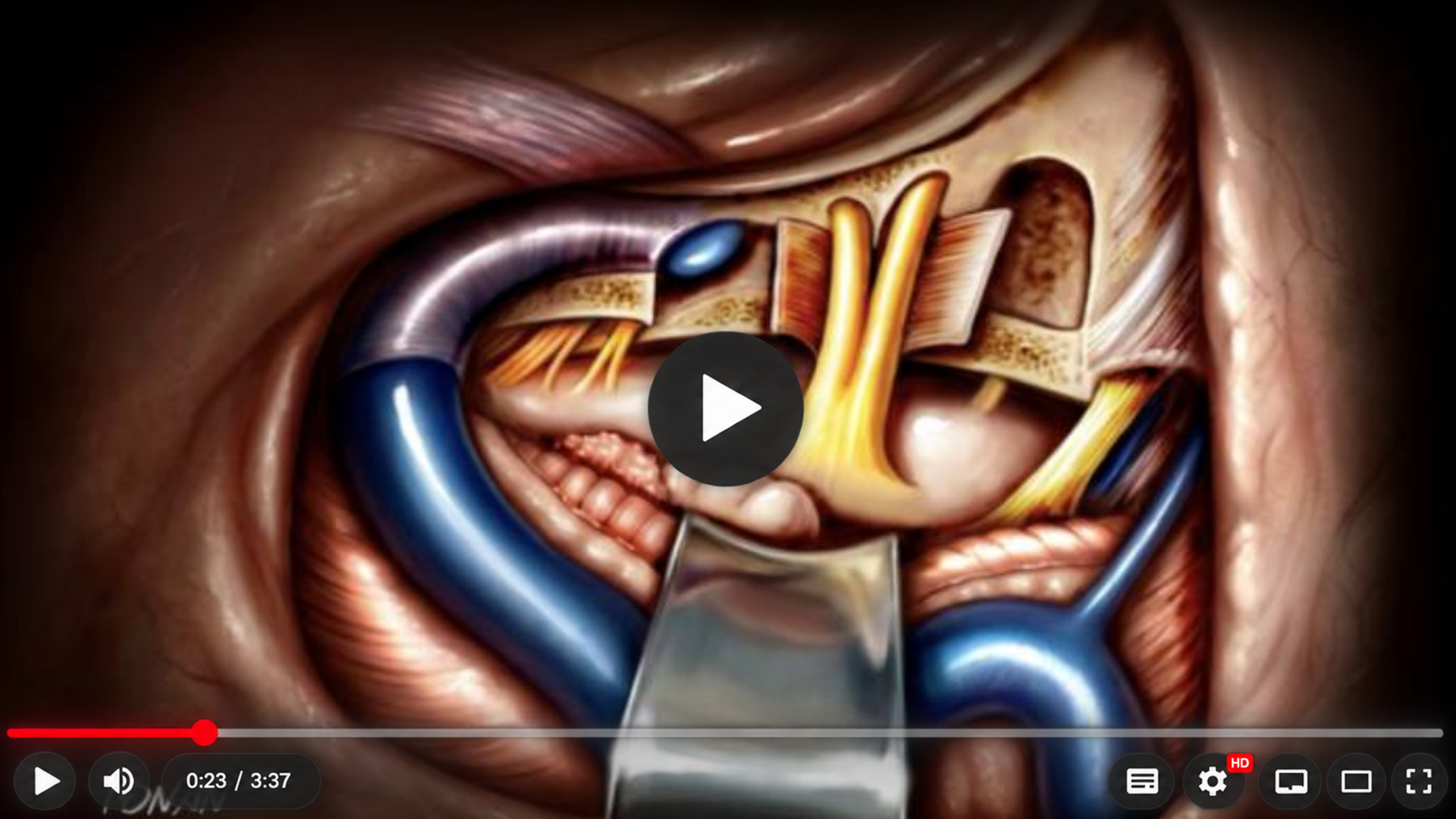 Ilustração do acesso translabiríntico ao osso temporal, mostrando nervos e vasos expostos no campo operatório.