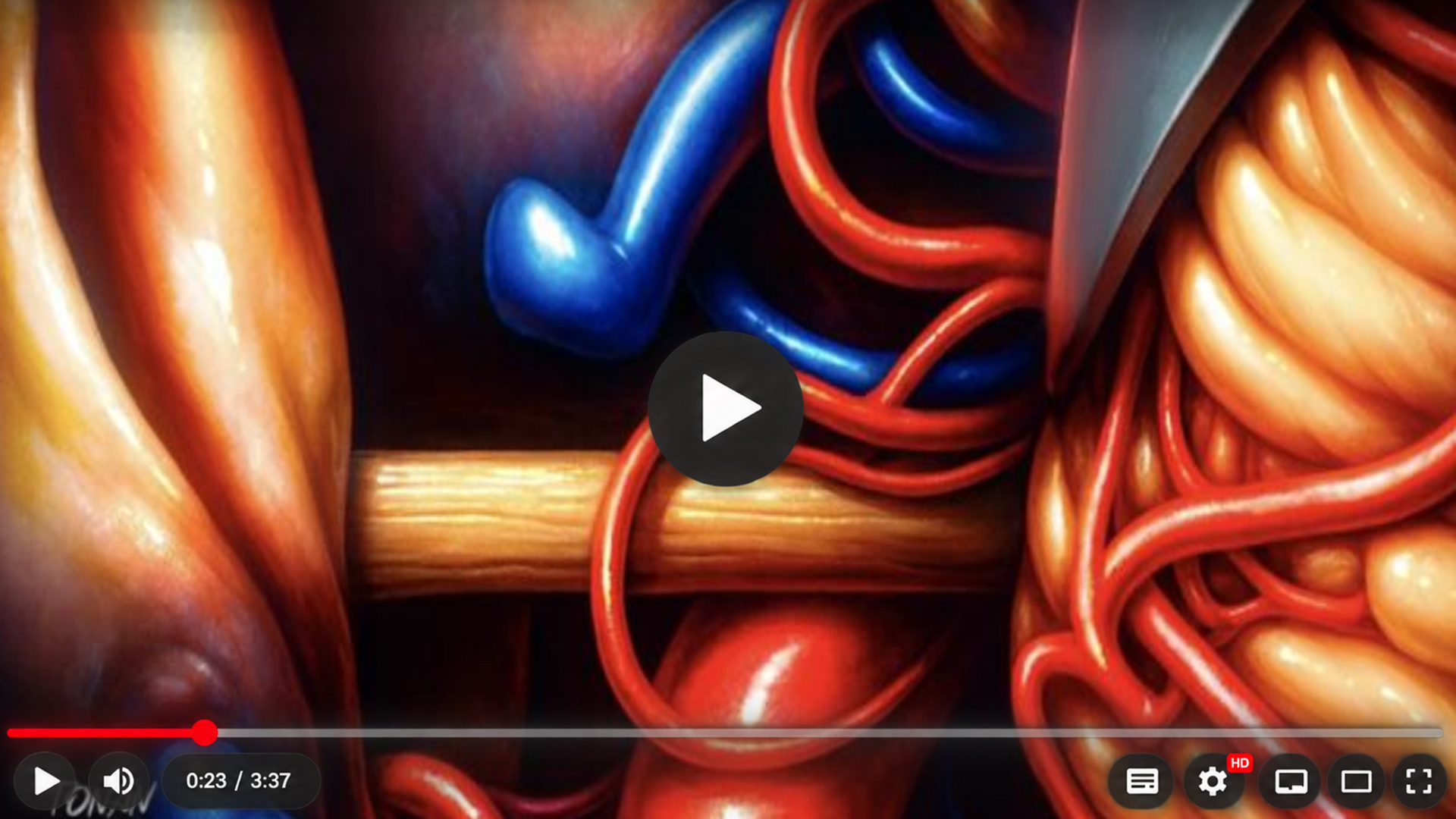 Ilustração anatômica de vasos e nervos no acesso a um pequeno tumor do canal auditivo interno.