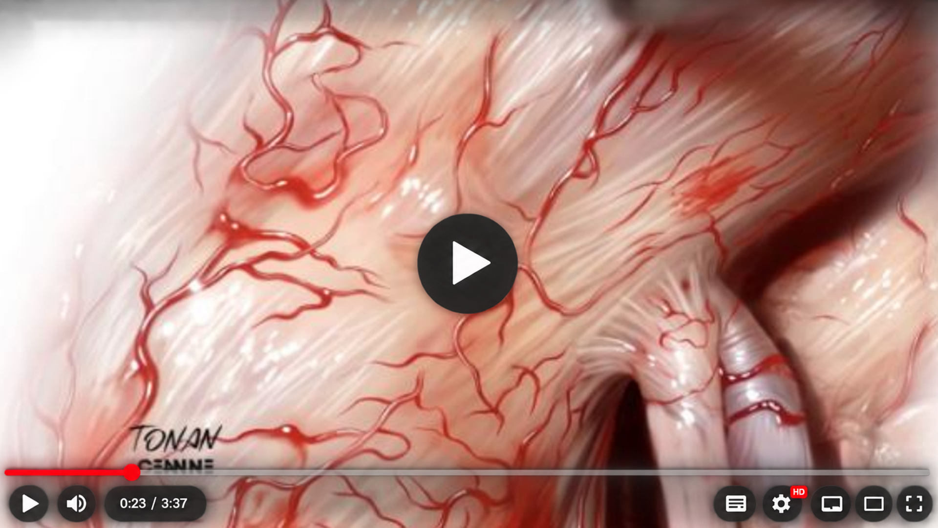 Ilustração da superfície do campo cirúrgico com um vaso arterial aderido à membrana dural e estruturas vasculares adjacentes.