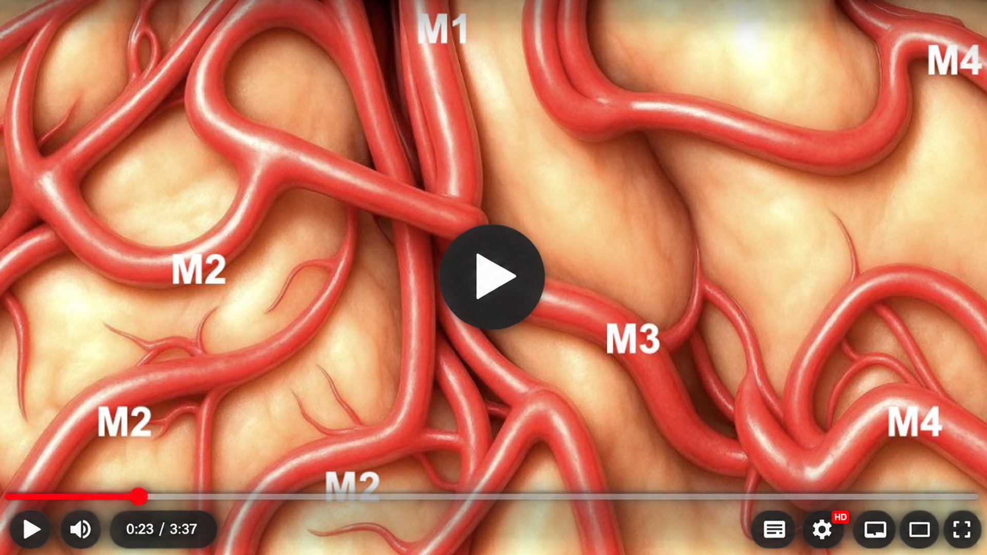 Ilustração de um aneurisma junto aos ramos da artéria cerebral média, com destaque para sua anatomia vascular.