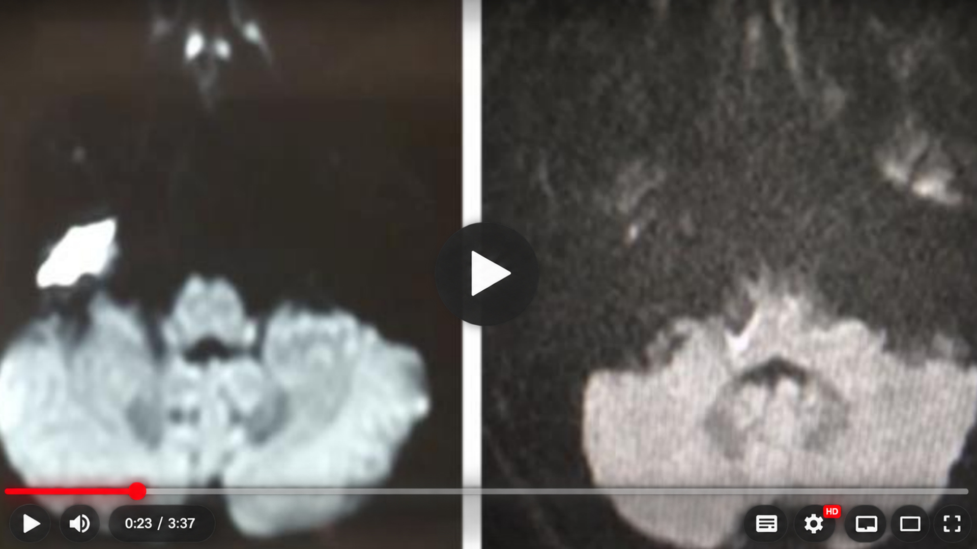 Duas imagens de ressonância magnética lado a lado, em preto e branco, utilizadas no resumo visual do colesteatoma do ápice petroso.