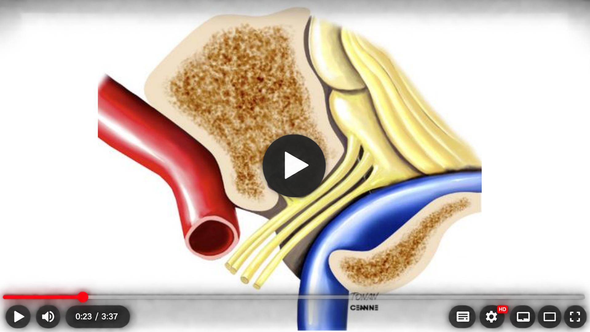 Ilustração anatômica da região do forame jugular, com vasos em vermelho e azul e nervos em amarelo junto ao osso temporal.