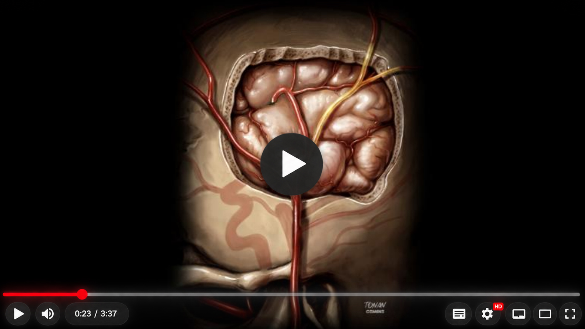 Reconstrução tridimensional da cabeça com uma abertura craniana e vasos utilizados na representação de bypass cerebral.