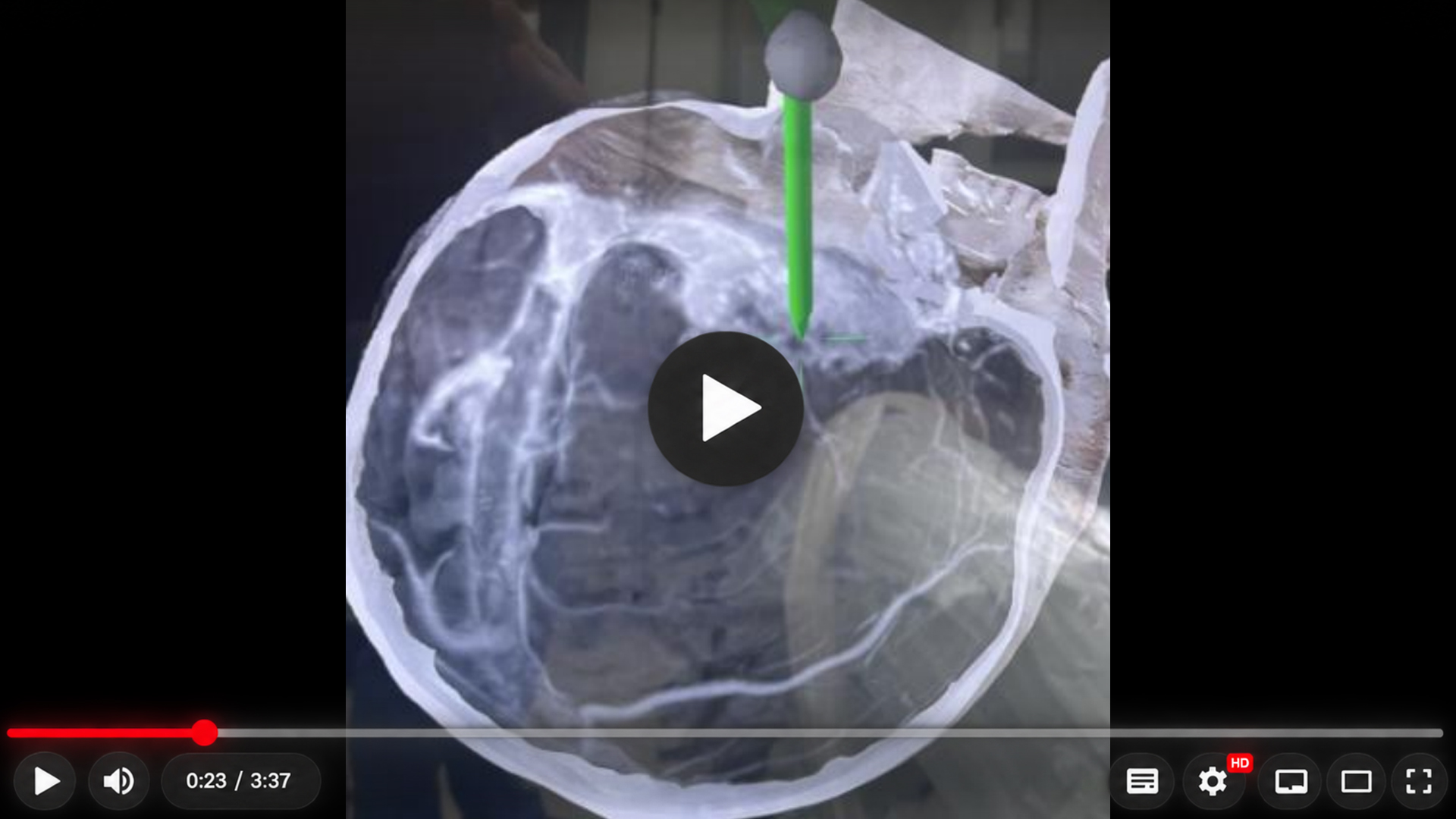 Reconstrução de imagem craniana utilizada no resumo visual do tumor fibroso solitário, com destaque gráfico na região posterior do crânio.