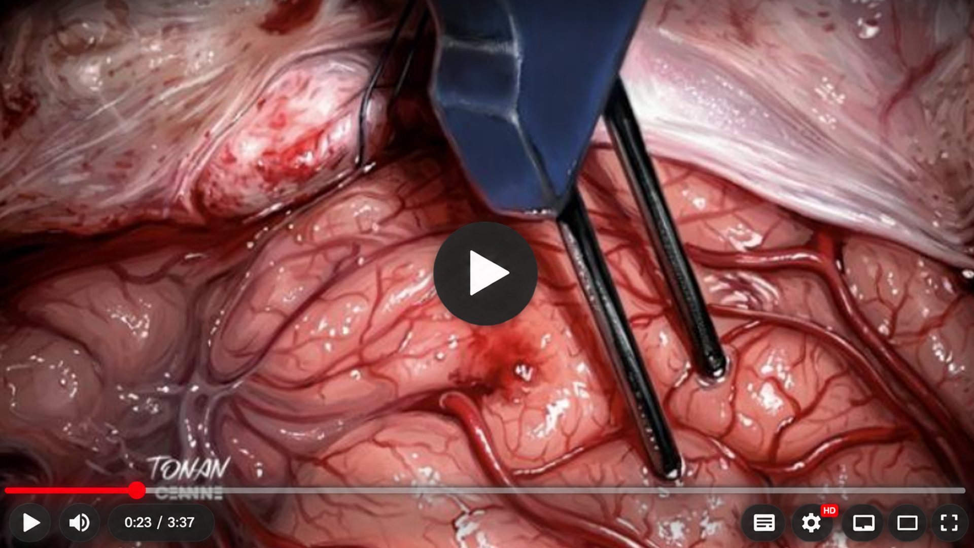 Imagem do campo microcirúrgico com tecido cerebral exposto, vasos e instrumentos durante o acesso a uma lesão insular.