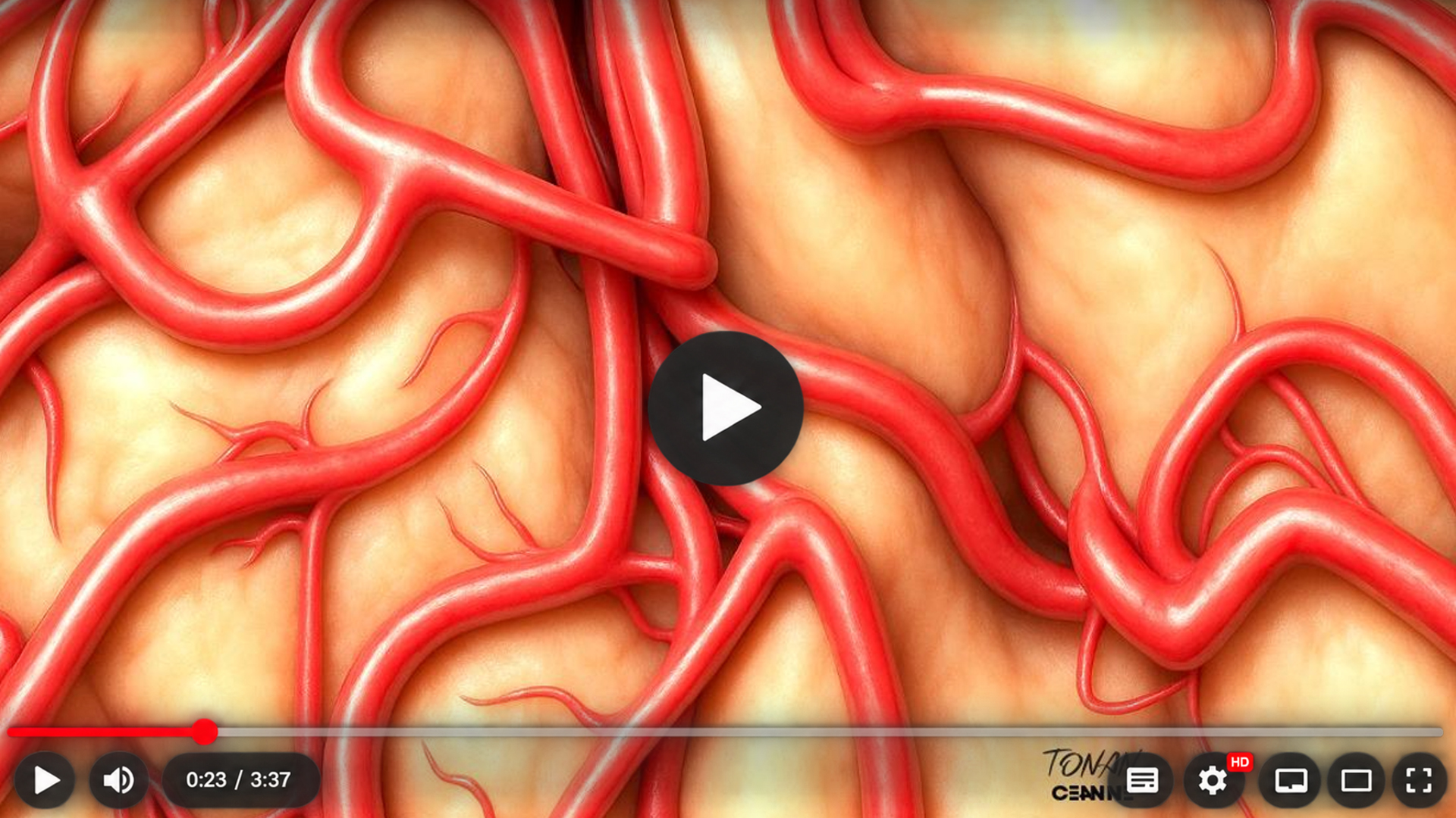 Ilustração de artérias corticais cerebrais e de uma conexão vascular utilizada para representar revascularização na doença de Moyamoya.