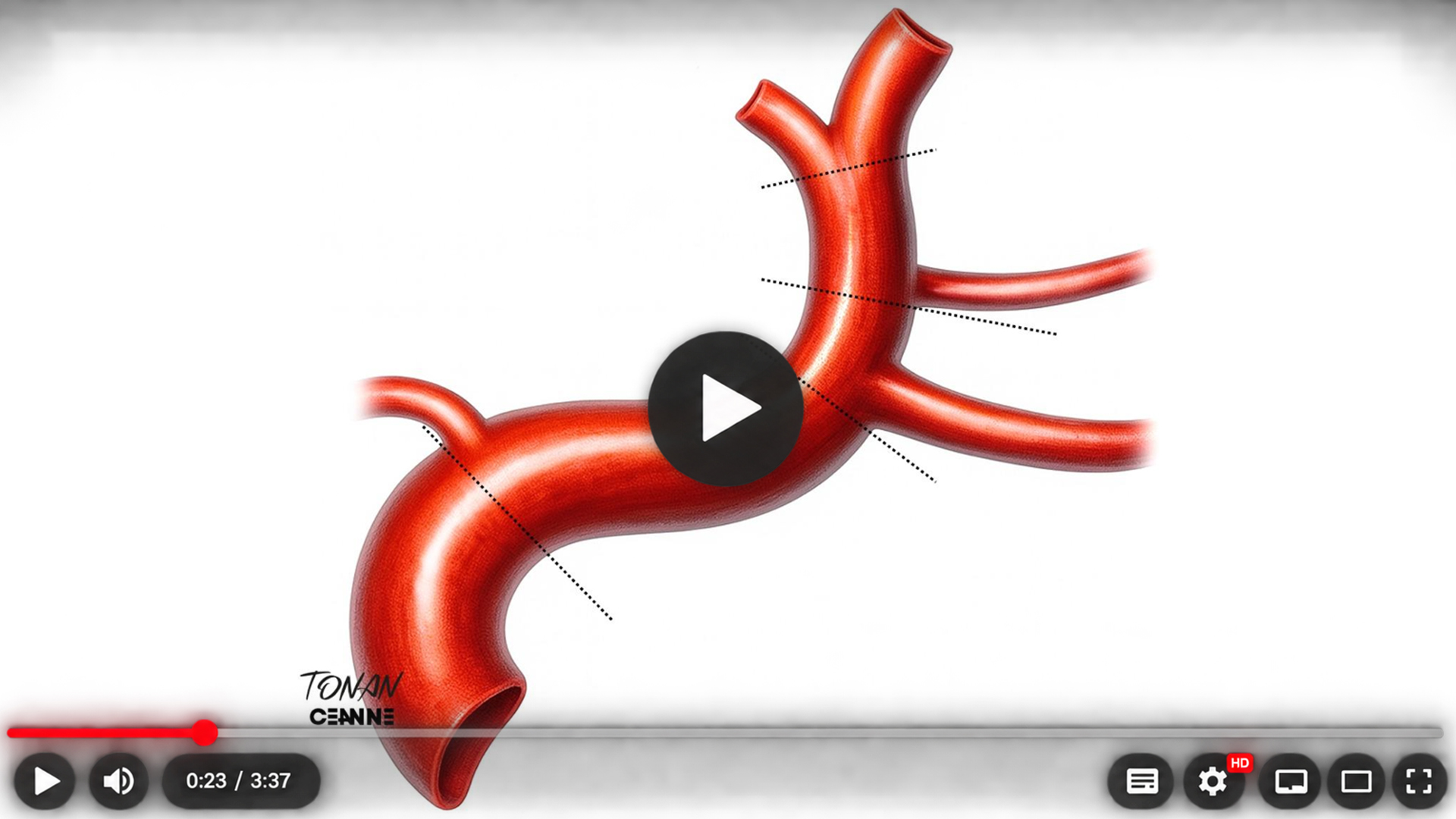 Ilustração de uma bifurcação arterial com dilatação aneurismática, sobre fundo claro, utilizada na abertura do vídeo cirúrgico.