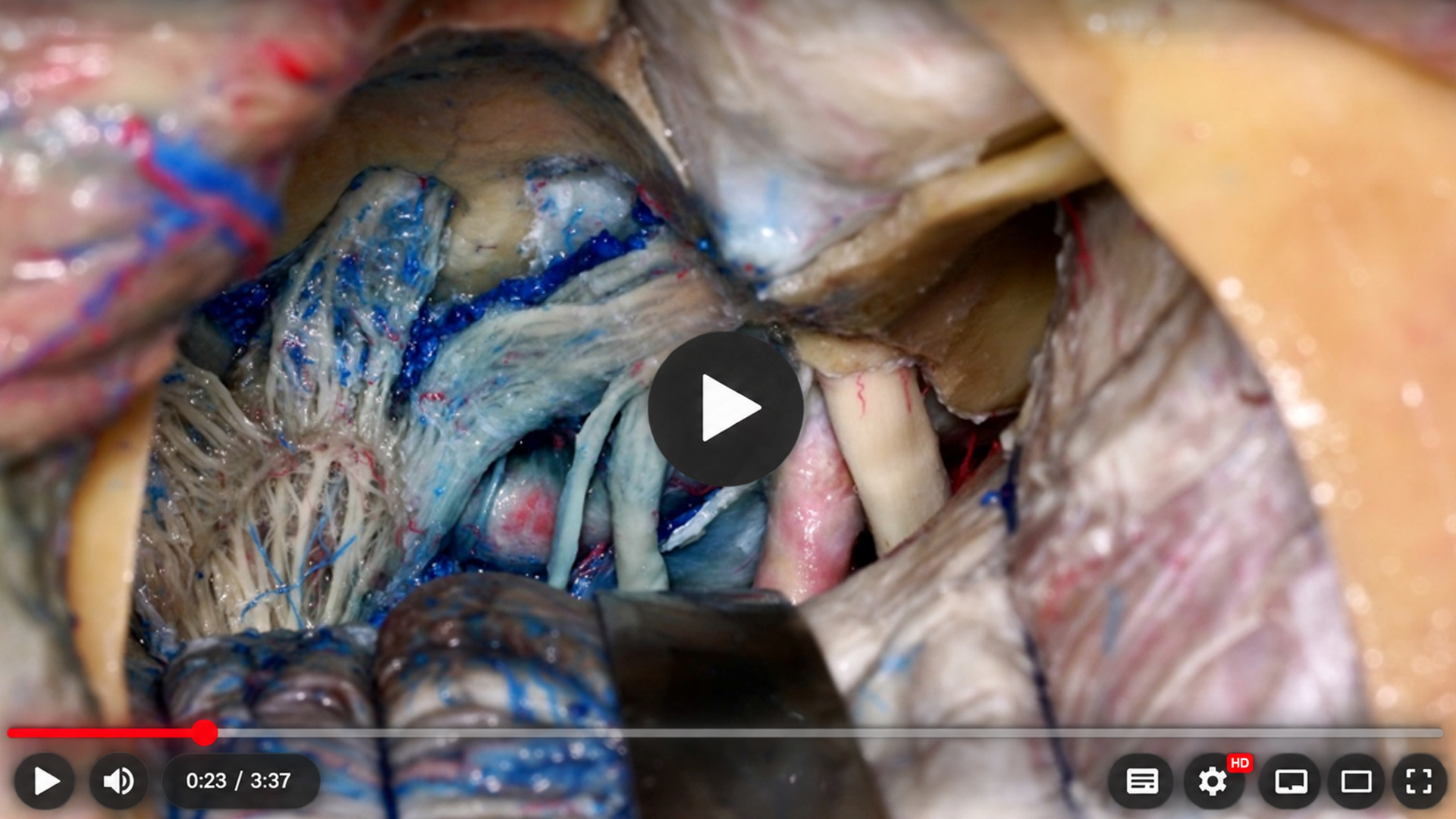 Imagem microanatômica da base do crânio com instrumentos e estruturas profundas expostas na região do acesso descrito no artigo.